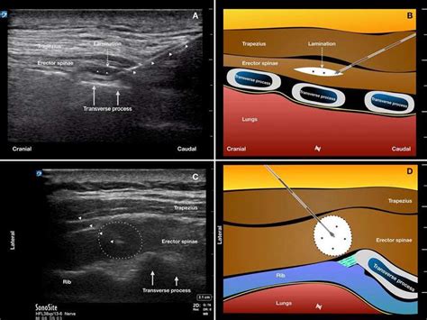 The Erector Spinae Plane Block: A Review of Current Evidence : Virtual ...