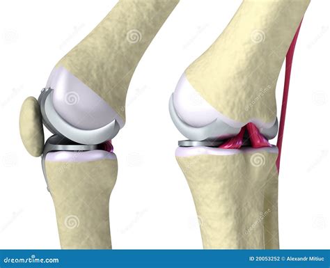 Knee and Titanium Hinge Joint Stock Illustration - Illustration of health, biology: 20053252