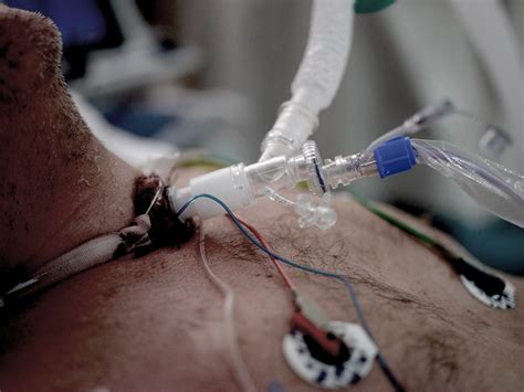 Tracheostomy Procedure