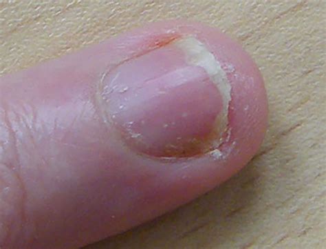 Photo Of Fingernail Psoriasis - pitting & discoloration