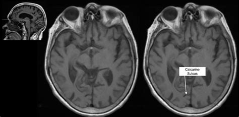 Radiological Anatomy: Calcarine Sulcus - Stepwards