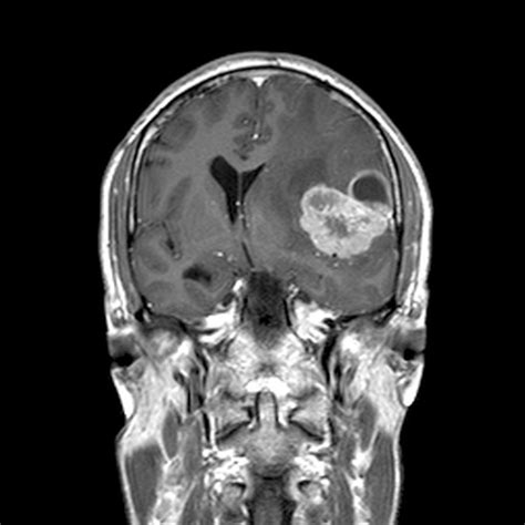 Brain Cancer Mri Images