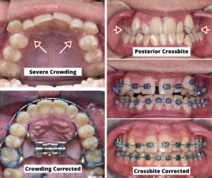 Palate Expanders - The Most Important Orthodontic Appliance