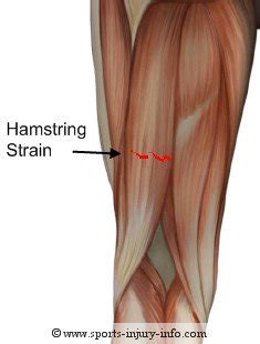 Hamstring Injury - Sports Injury Info