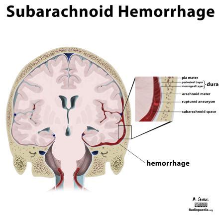 Subarachnoid Space Hemorrhage Ultrasound