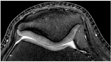 Figure 12 from A new MRI grading system for chondromalacia patellae | Semantic Scholar