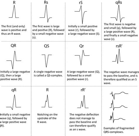 ECG interpretation: Characteristics of the normal ECG (P-wave, QRS ...