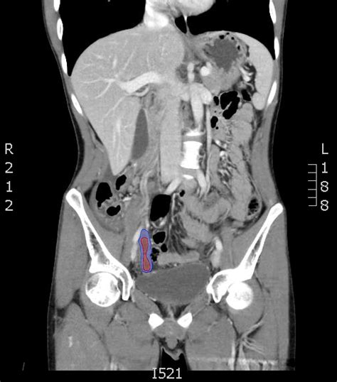 Computed Tomography Diagnosis of Appendicitis - JETem