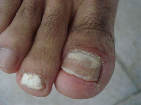 Proximal white subungual onychomycosis | Download Scientific Diagram