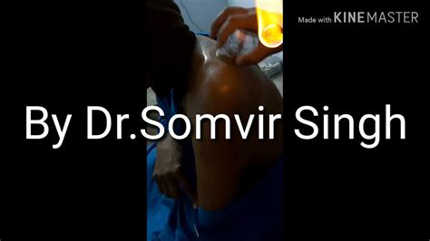 Frozen Shoulder Treatment by Dr. Somvir Singh 9812613024 by ayurvedic neurotherapy - YouTube