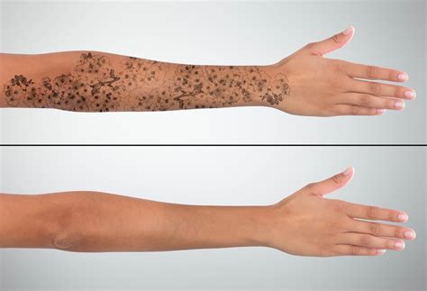 The PicoWay® Laser—The Next Level of Tattoo Removal | Precision MD Blog