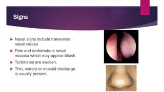 Nasal Discharge - ENT | PPT