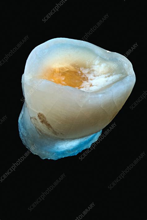 Milk tooth - Stock Image - C057/8504 - Science Photo Library