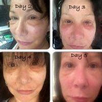 Lower Facelift Recovery Photos » Facelift: Info, Prices, Photos ...