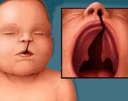 Síndrome de Patau - Trissomia do cromossomo 13 | Mundo Biologia