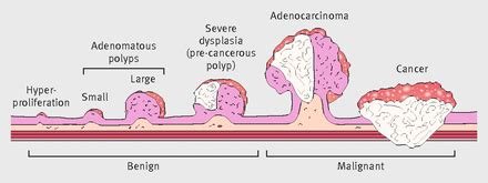 Colorectal adenocarcinoma: risks, prevention and diagnosis | The BMJ