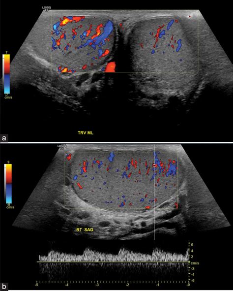 Testicular Hernia Ultrasound