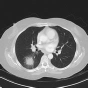 Pulmonary mucormycosis | Radiology Reference Article | Radiopaedia.org