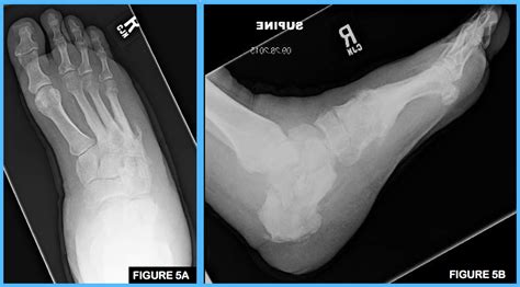 Revisiting Complications And Learning From Failures Of Syme’s Amputations