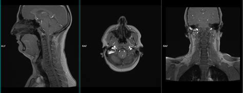 MRI soft tissue neck planning and protocols | Indications for MRI neck scan