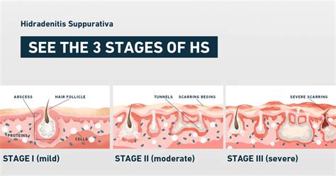 Mild Hidradenitis Suppurativa Inner Thigh