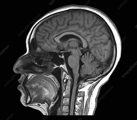 Healthy pineal gland, MRI scan - Stock Image - C055/1828 - Science Photo Library