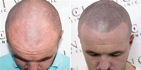 Bald Men Are Getting Head Tattoos To Hide Their Baldness