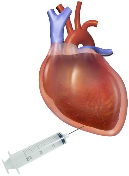 Pericardial Fluid - Urinalysis and Body Fluids