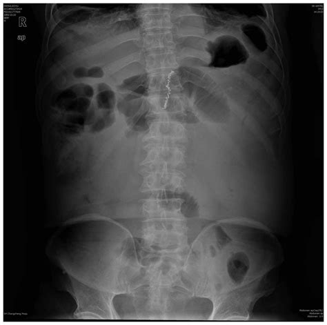 Paralytic ileus due to a novel anticancer drug, nab‑paclitaxel: A case ...