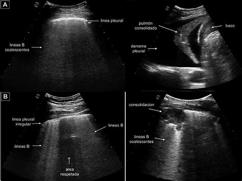 Ultrasonido pulmonar en el manejo del paciente crítico. Conceptos básicos y aplicación clínica ...