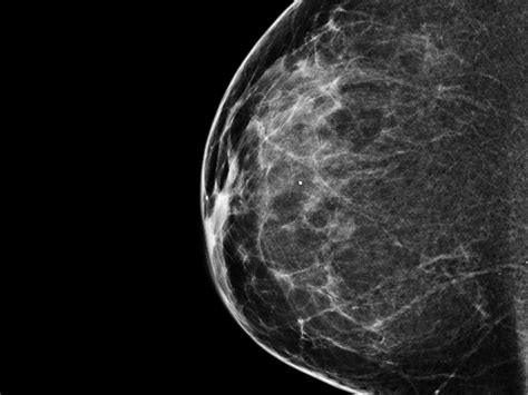 When You Need A Mammogram, Should You Get One In '3-D'? | WBUR News