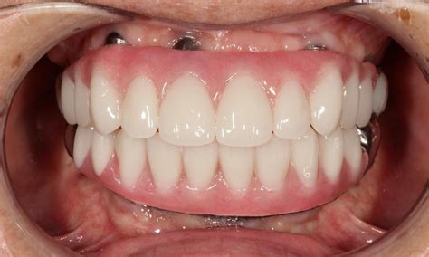 Hybrid Denture All-On-Four in Aurora CO | Before & After