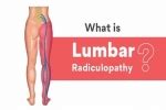 Blog | Pain Management: Lumbar Radiculopathy