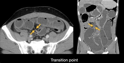 Abdominal CT: small bowel obstruction • LITFL • Radiology Library