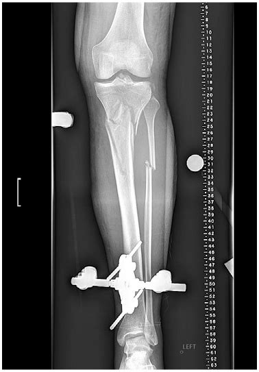 Managing High-Energy, Proximal Tibia and Fibula Fracture | HSS Case