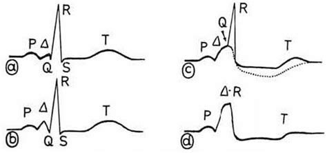 Delta Wave • LITFL Medical Blog • ECG Library Basics