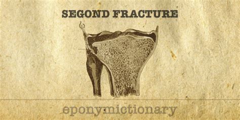 Segond fracture • LITFL Medical Blog • Medical Eponym Library