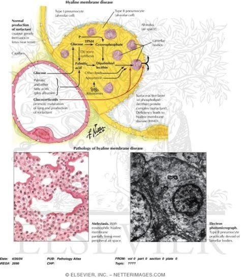 Hyaline Membrane Disease