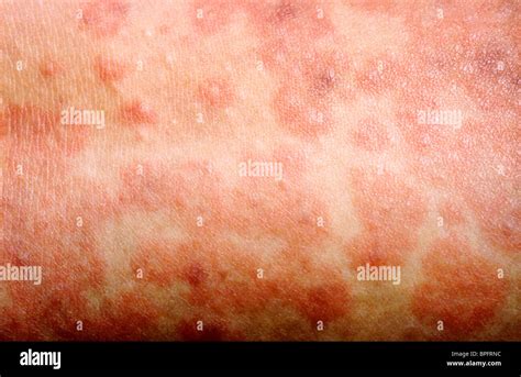 Maculopapular rash hi-res stock photography and images - Alamy