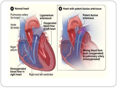 Congenital Heart Disease