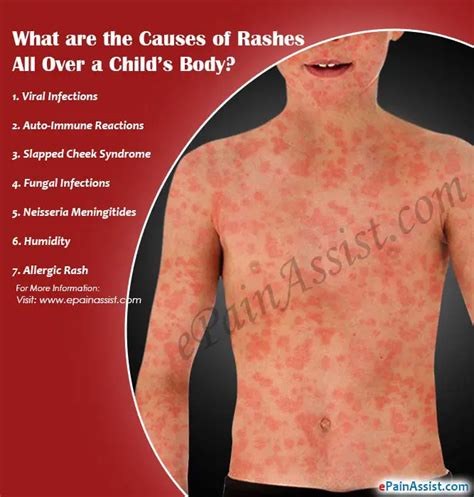 Causes of Rashes All Over a Child’s Body & What Can You Do?