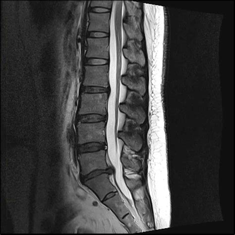 MRI of the Lower Back | Melbourne Radiology