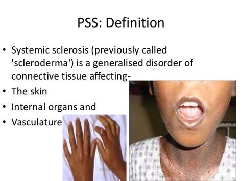 Progresive systemic sclerosis