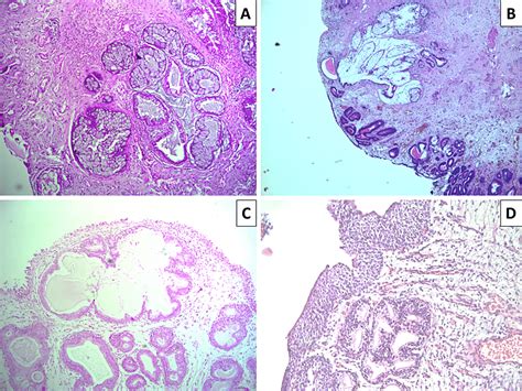 Intestinal-Type Adenocarcinoma of the Urinary Bladder With Coexisting ...