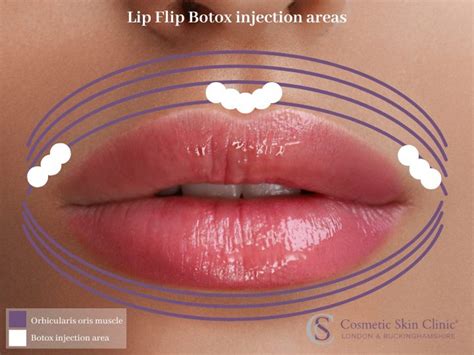 Everything you need to know about Lip Flip with Botox - The Cosmetic Skin Clinic