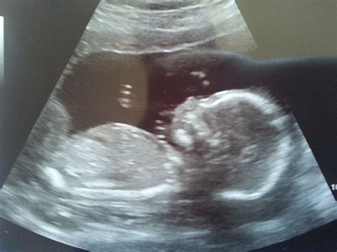 Baby Blyth: Ultrasound 19 weeks / Echographie - C'est un garcon!! It's ...