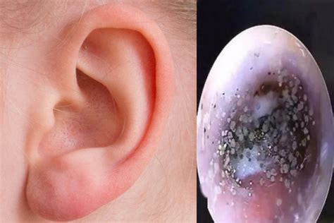 'Mould' found growing in boy's ear canal, said to be due to wearing earphones too often ...