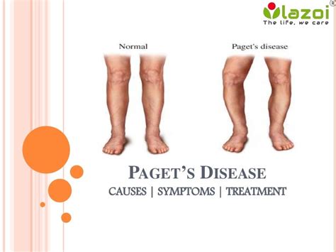 Paget’s disease : causes, symptoms, diagnosis and treatment