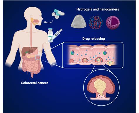 Colorectal Cancer Treatment