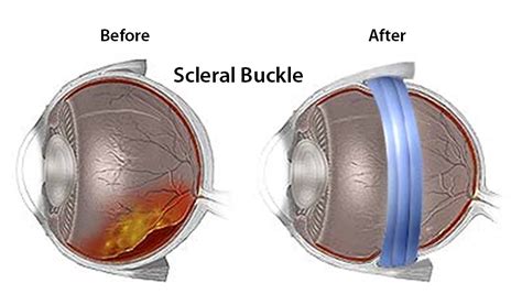 Storm Anesthesia - Eye treatment modalities